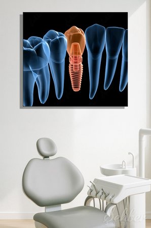 Küçük Azı (Premolar) Dental İmplant Tıbbi 3D İllüstrasyon Yatay Kanvas Tablo Tekli 3652