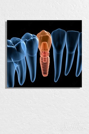 Küçük Azı (Premolar) Dental İmplant Tıbbi 3D İllüstrasyon Yatay Kanvas Tablo Tekli 3652