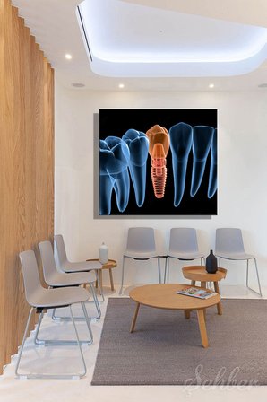 Küçük Azı (Premolar) Dental İmplant Tıbbi 3D İllüstrasyon Yatay Kanvas Tablo Tekli 3652