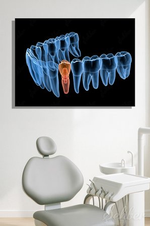 Diş İmplantı (Yapay Diş Kökü) Tıbbi Ve Anatomik 3 Boyutlu İllüstrasyon Yatay Kanvas Tablo Tekli 3659