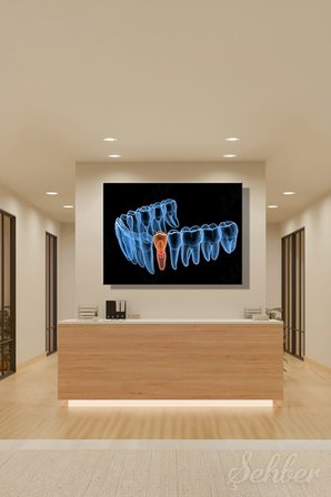 Diş İmplantı (Yapay Diş Kökü) Tıbbi Ve Anatomik 3 Boyutlu İllüstrasyon Yatay Kanvas Tablo Tekli 3659