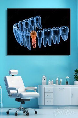 Diş İmplantı (Yapay Diş Kökü) Tıbbi Ve Anatomik 3 Boyutlu İllüstrasyon Yatay Kanvas Tablo Tekli 3659