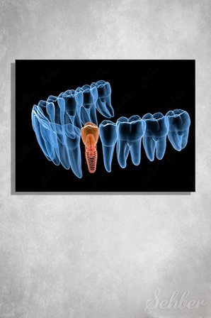 Diş İmplantı (Yapay Diş Kökü) Tıbbi Ve Anatomik 3 Boyutlu İllüstrasyon Yatay Kanvas Tablo Tekli 3659