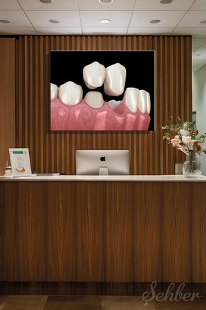 Sabit Diş Köprüsü (Dental Bridge) 3D Aşamalı Bir Animasyonu Yatay Kanvas Tablo Tekli 3662
