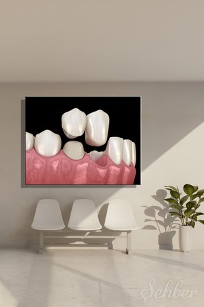 Sabit Diş Köprüsü (Dental Bridge) 3D Aşamalı Bir Animasyonu Yatay Kanvas Tablo Tekli 3662