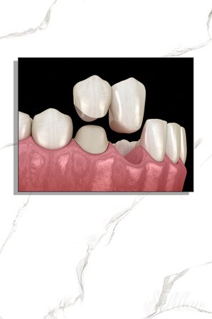 Sabit Diş Köprüsü (Dental Bridge) 3D Aşamalı Bir Animasyonu Yatay Kanvas Tablo Tekli 3662