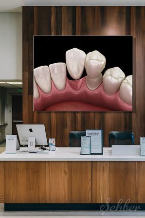 Maryland Köprü (Kanatlı Köprü) Sisteminin 3D Tıbbi Modellemesi Yatay Kanvas Tablo Tekli 3672