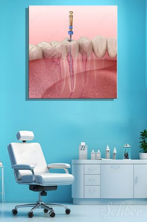 Kök Kanal Tedavisini (Endodontik Tedavi)  3D Tıbbi Bir İllüstrasyonu Kare Kanvas Tablo Tekli 3692