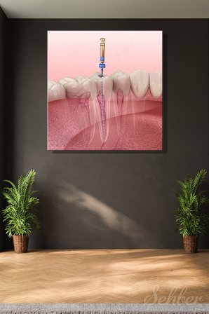Kök Kanal Tedavisini (Endodontik Tedavi)  3D Tıbbi Bir İllüstrasyonu Kare Kanvas Tablo Tekli 3692
