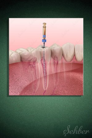 Kök Kanal Tedavisini (Endodontik Tedavi)  3D Tıbbi Bir İllüstrasyonu Kare Kanvas Tablo Tekli 3692