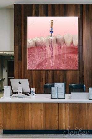 Kök Kanal Tedavisini (Endodontik Tedavi)  3D Tıbbi Bir İllüstrasyonu Kare Kanvas Tablo Tekli 3692