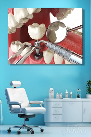 Yapay Diş Kökünün Çene Kemiğine Yerleştirilmesi 3D Modelleme Yatay Kanvas Tablo 4231