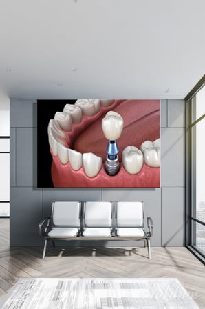 Diş Kronunu (Kaplamayı) Gösteren Tıbbi Bir 3D İllüstrasyon Yatay Kanvas Tablo 3448