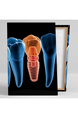 Ağız Ve Diş Sağlığı Implant Dişçi Ofis Kanvas Tablo T
