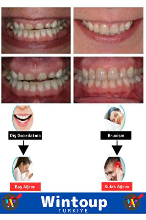 Premium Çene Sıkma Diş Gıcırdatma Bruxism Gece Plağı Koruyucu Aparatı Dişlik Uyku Aparatı 2 Adet