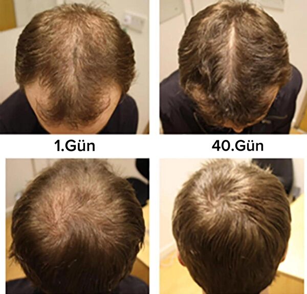 Purexpose Saç Serumu